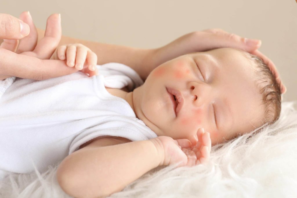 mother hands touching sleeping little child with red rash, closeup. Concept of babies allergies