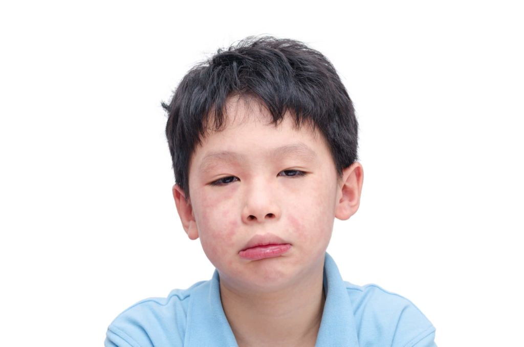 Young asian child face with rash over white background